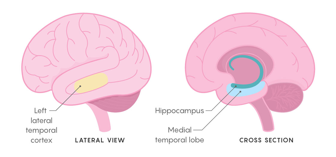 GRAPHIC: LOCATOR IMAGE FOR LATERAL TEMPORAL CORTEX