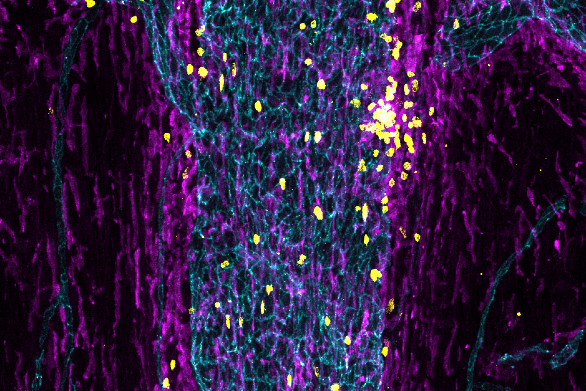 Microscopy image in which immune cells stained yellow and purple crowd in and around a sinus.