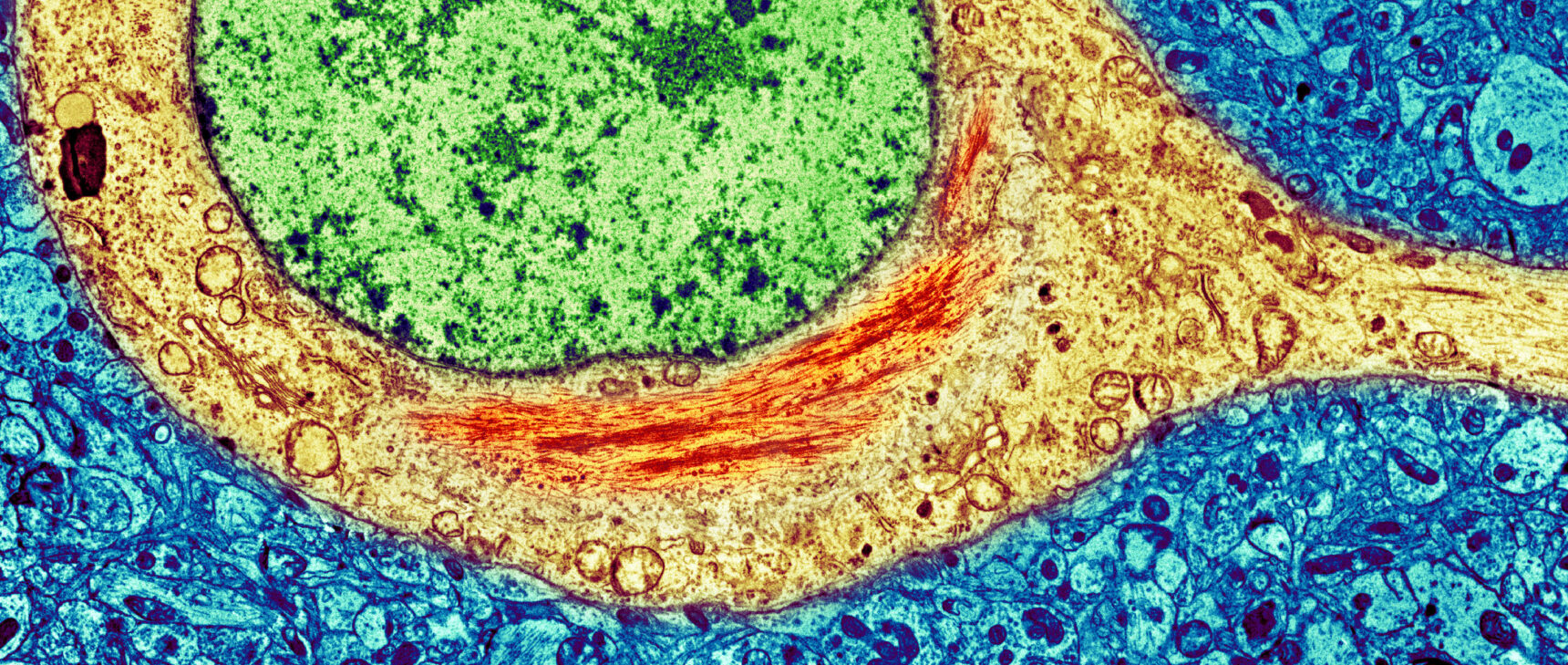 Micrograph of a neuron showing aggregations of tau protein.