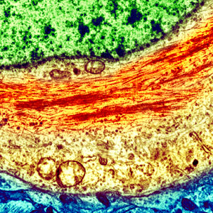 Micrograph of a neuron showing aggregations of tau protein.