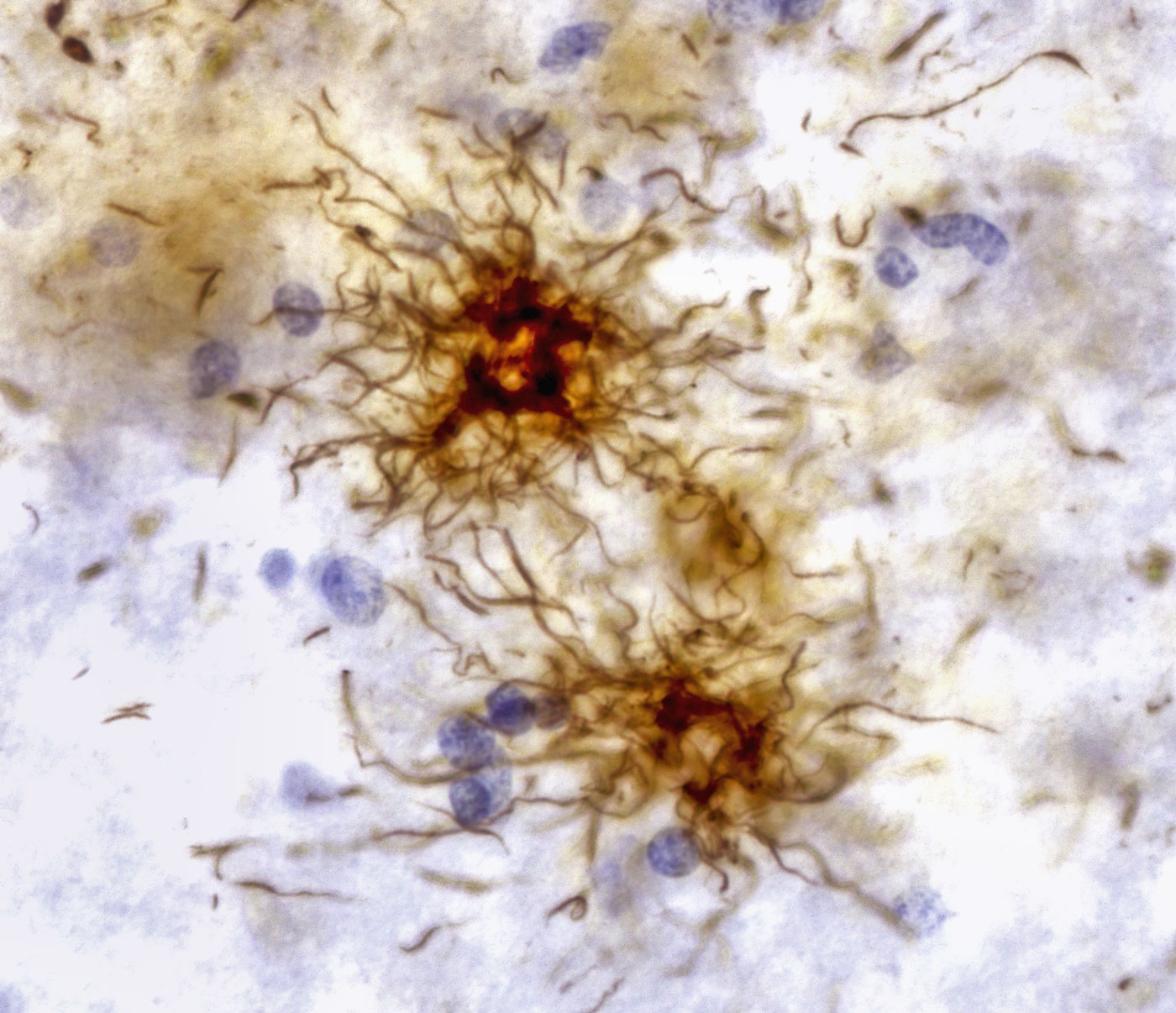 Micrograph of stained brain tissue from a patient with progressive supranuclear palsy.