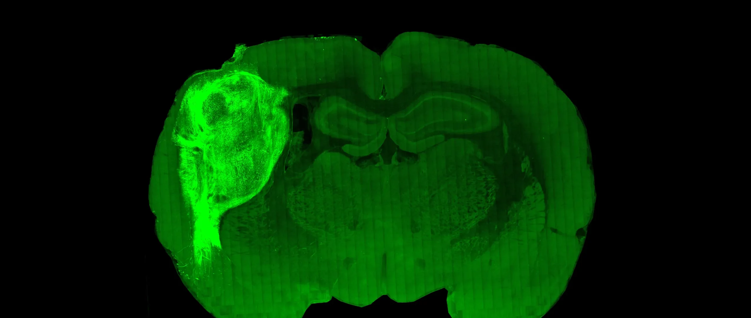 Green cross section of a brain with a large bright area in its left hemisphere.