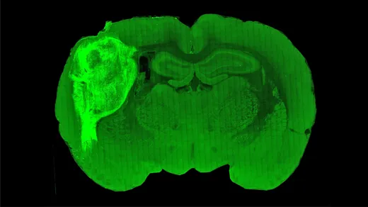 Green cross section of a brain with a large bright area in its left hemisphere.