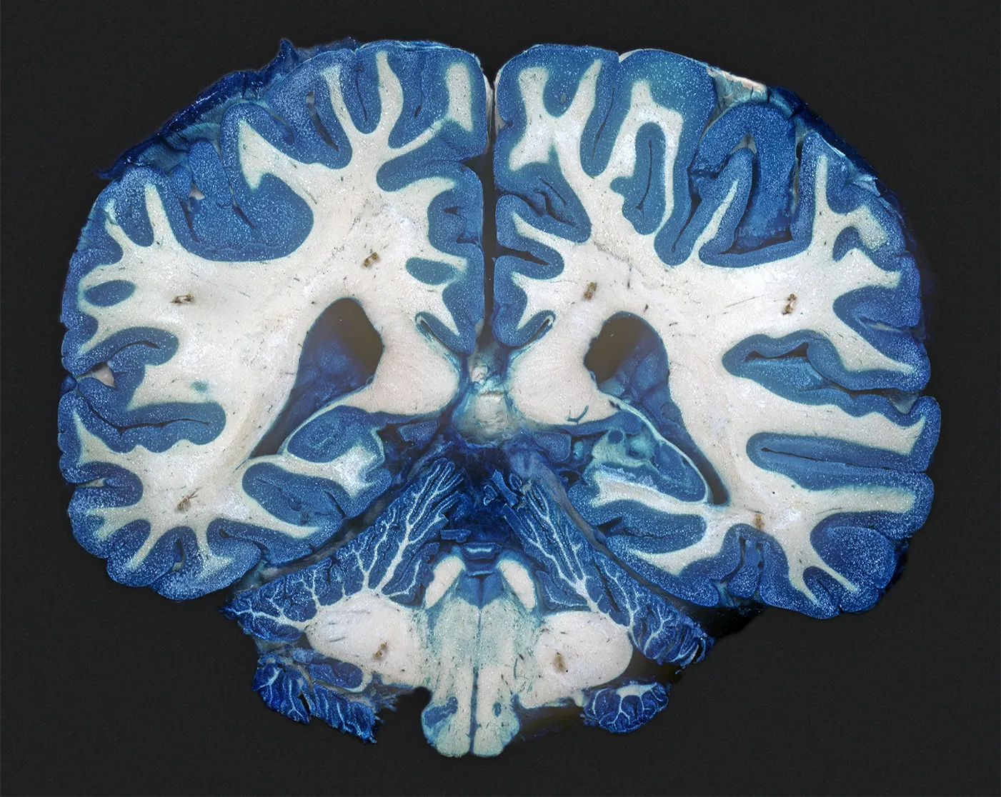 A cross section of human brain that shows the distinct “gray matter” and “white matter” areas.