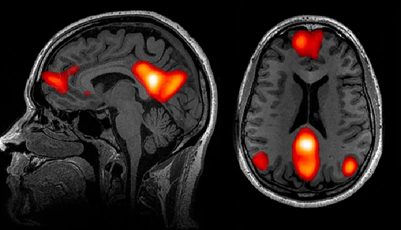 Scans of a human brain viewed from the side and top, showing bright areas of activity in the prefrontal cortex, the angular gyrus and the posterior cingulate cortex.