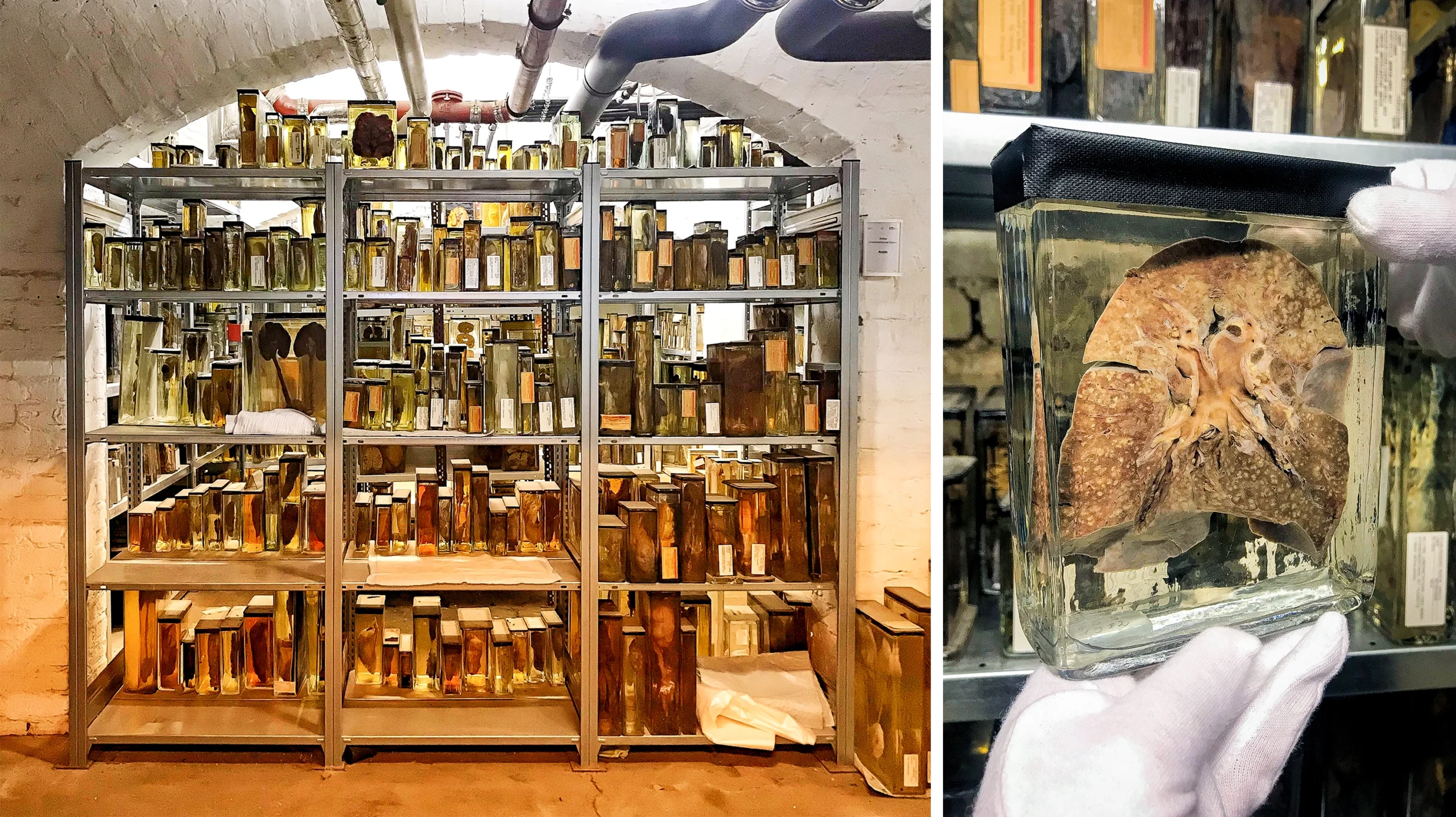 A shelf is stacked with glass jars — medical specimens preserved in formalin. Right: A preserved lung in a jar.